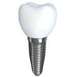 dental-implant-houston-tx