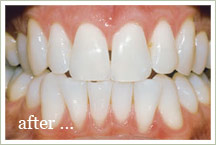 Teeth Whitening - galleria area Houston TX (713) 484-8484